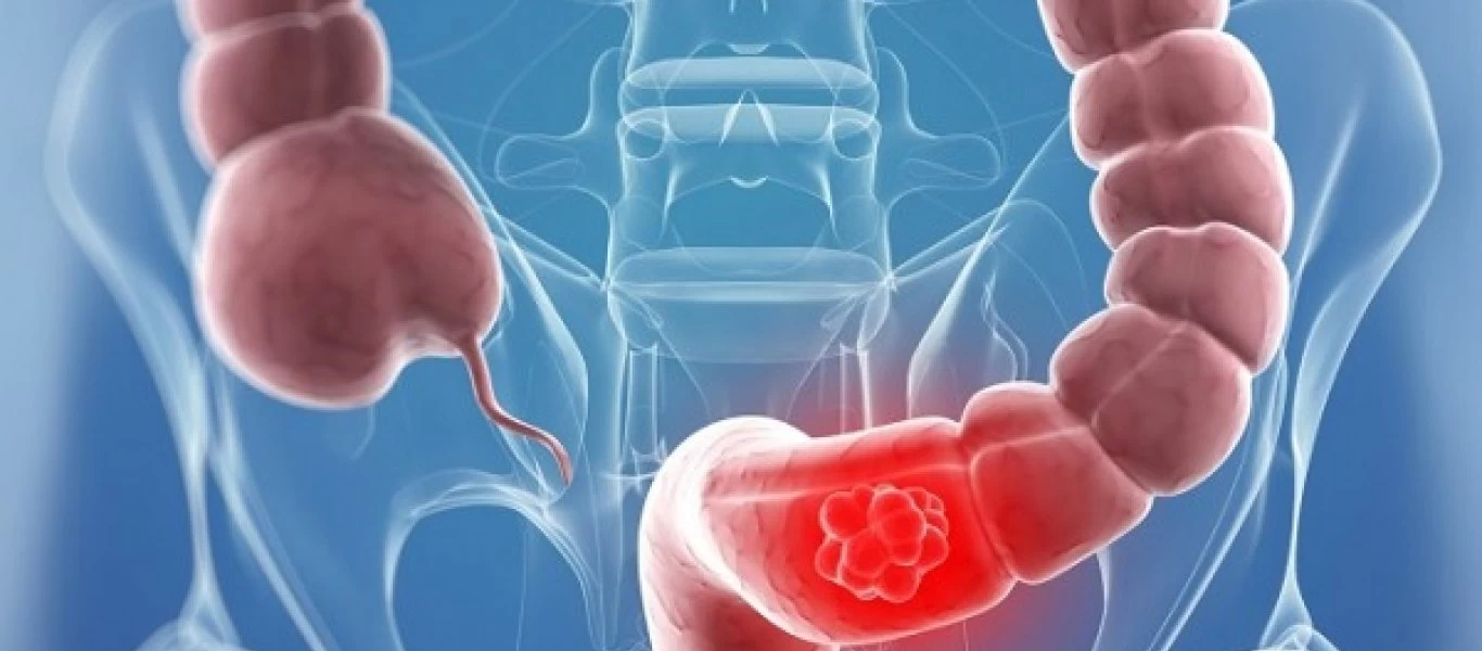 Αν τρώτε αυτό δυο φορές την εβδομάδα μειώνετε τον κίνδυνο για καρκίνο του παχέος εντέρου